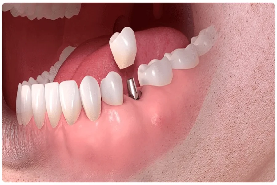 How long do dental implants take in Istanbul, Turkey